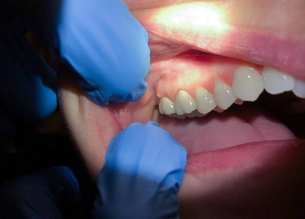 Best Chipped Tooth Repair Near Me  in Little Silver, NJ